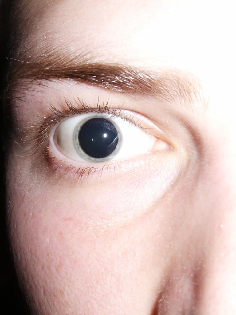 Dilated_pupils_2006.jpg