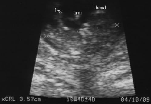 09/16 10 weeks 4 days